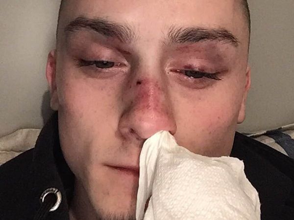 Gay Couple Attacked with Hammer by Balaclava-Wearing Gang