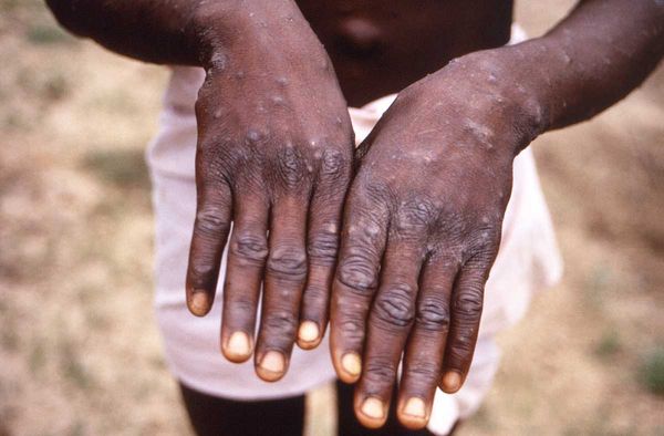 Monkeypox Isn't Like HIV, but Gay and Bisexual Men Are at Risk of Unfair Stigma