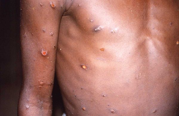 Africans See Inequity in Monkeypox Response Elsewhere
