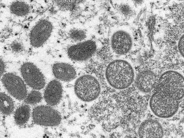 Monkeypox Virus Could Become Entrenched as New STD in the US